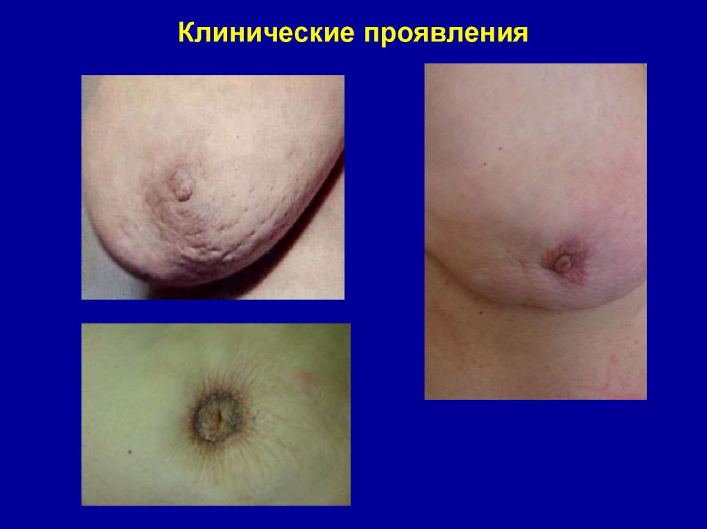 Клинические проявления