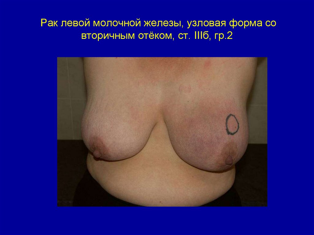 Рак левой молочной железы, узловая форма со вторичным отёком, ст. IIIб, гр.2