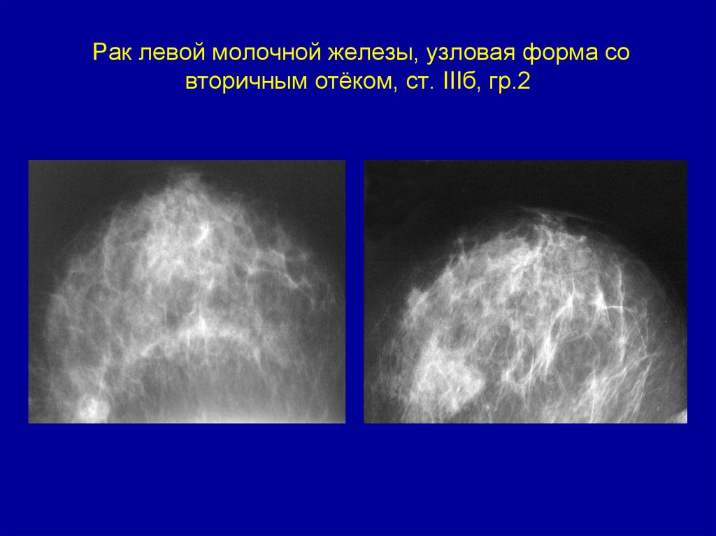 Рак левой молочной железы, узловая форма со вторичным отёком, ст. IIIб, гр.2