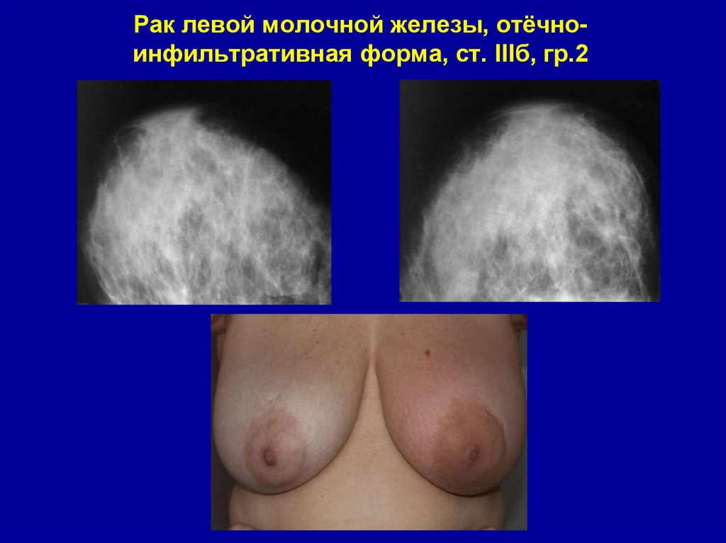 Рак левой молочной железы, отёчно-инфильтративная форма, ст. IIIб, гр.2