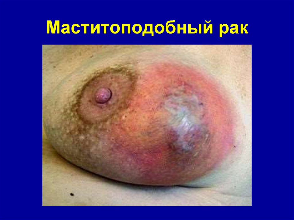 Маститоподобный рак