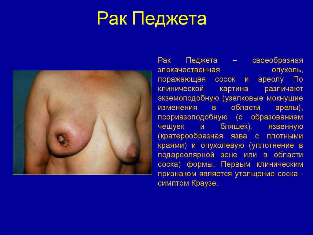 Рак Педжета