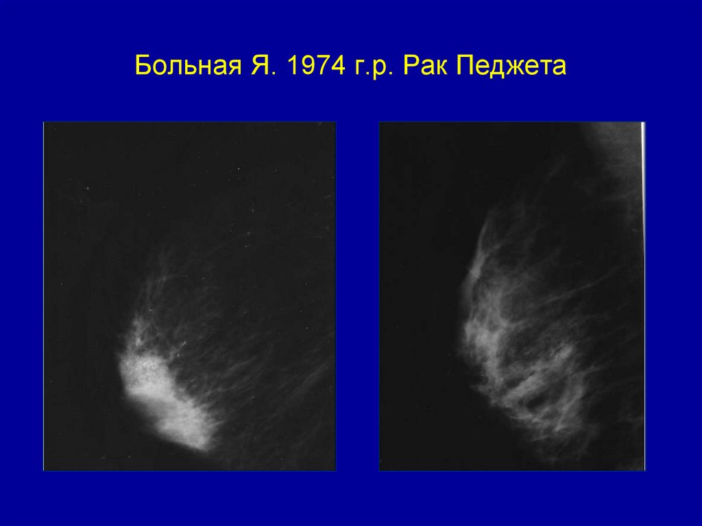 Больная Я. 1974 г.р. Рак Педжета