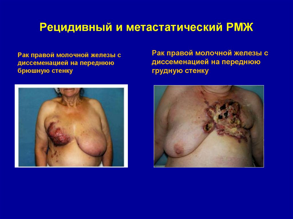 Рецидивный и метастатический РМЖ