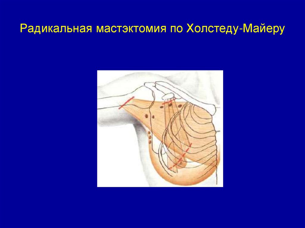 Радикальная мастэктомия по Холстеду-Майеру