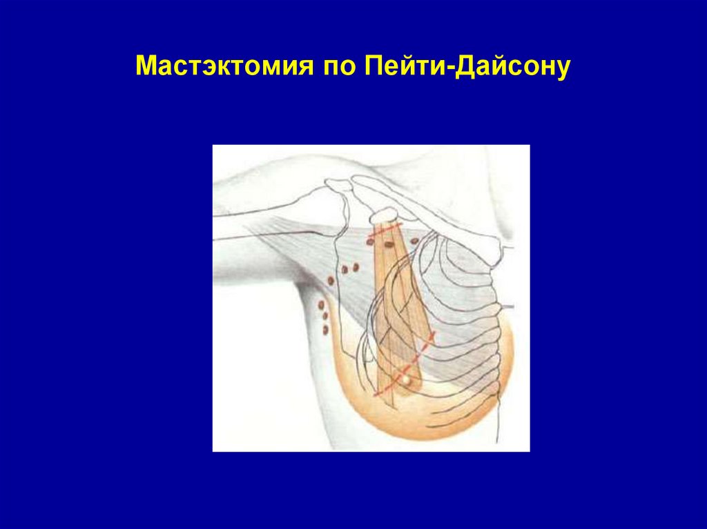 Мастэктомия по Пейти-Дайсону