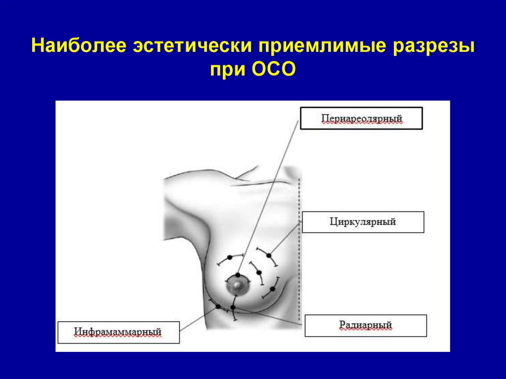 Наиболее эстетически приемлимые разрезы при ОСО