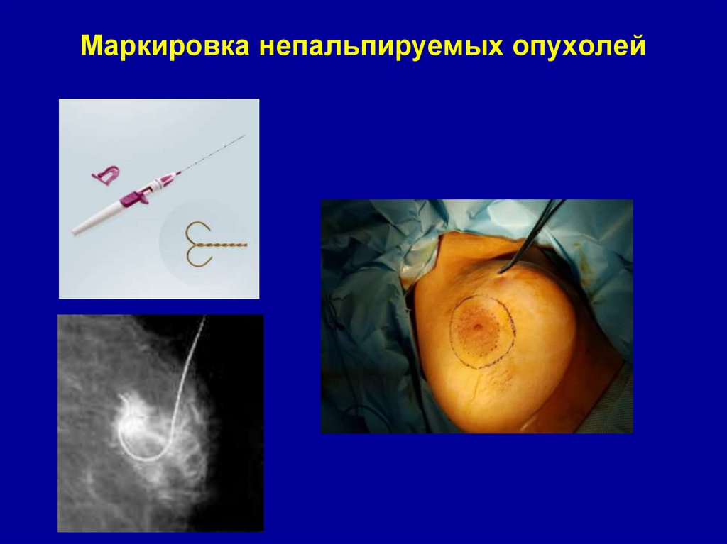Маркировка непальпируемых опухолей
