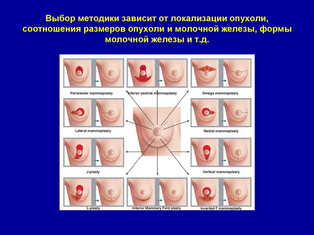 Выбор методики зависит от локализации опухоли, соотношения размеров опухоли и молочной железы, формы молочной железы и т.д.