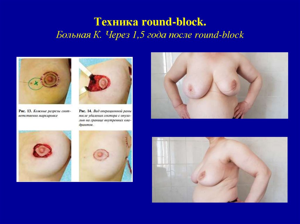 Техника round-block. Больная К. Через 1,5 года после round-block