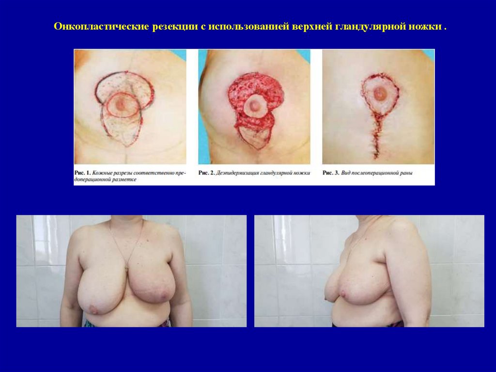 Онкопластические резекции с использованией верхней гландулярной ножки .