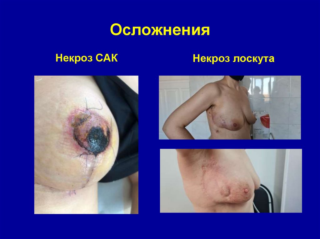 Осложнения