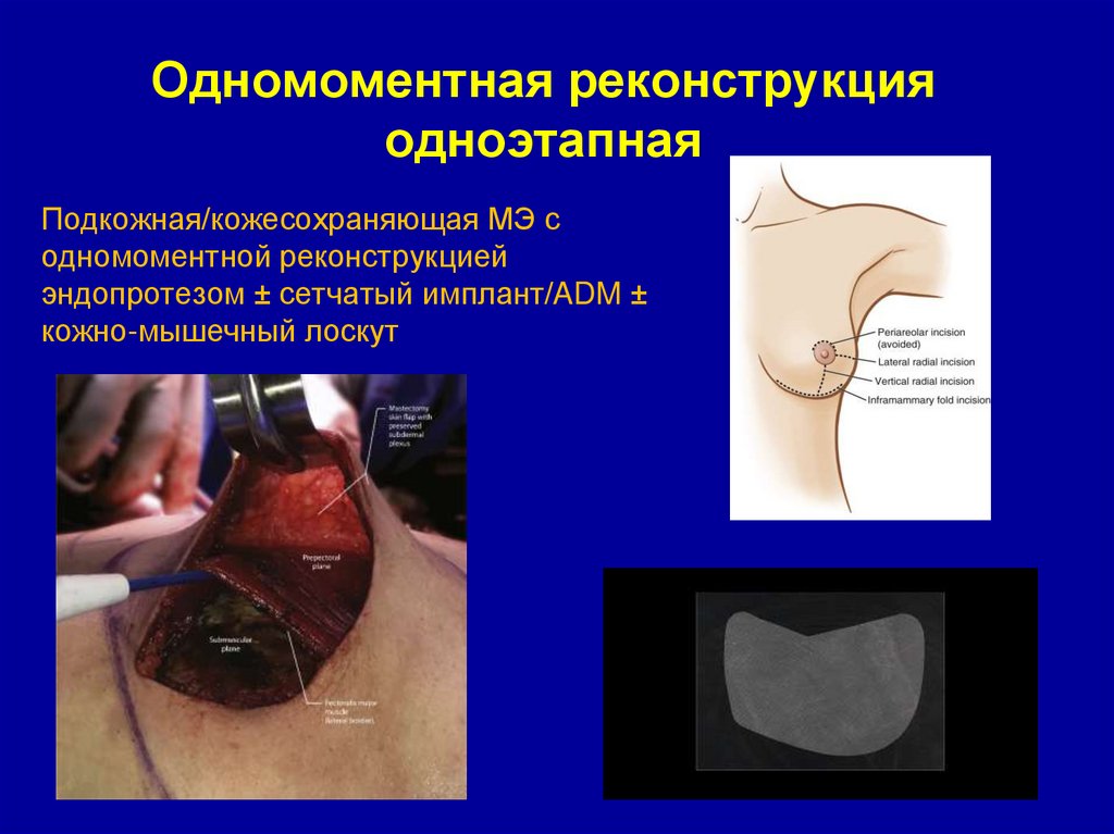 Одномоментная реконструкция одноэтапная