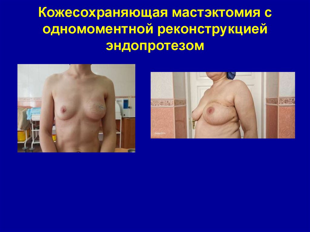 Кожесохраняющая мастэктомия с одномоментной реконструкцией эндопротезом