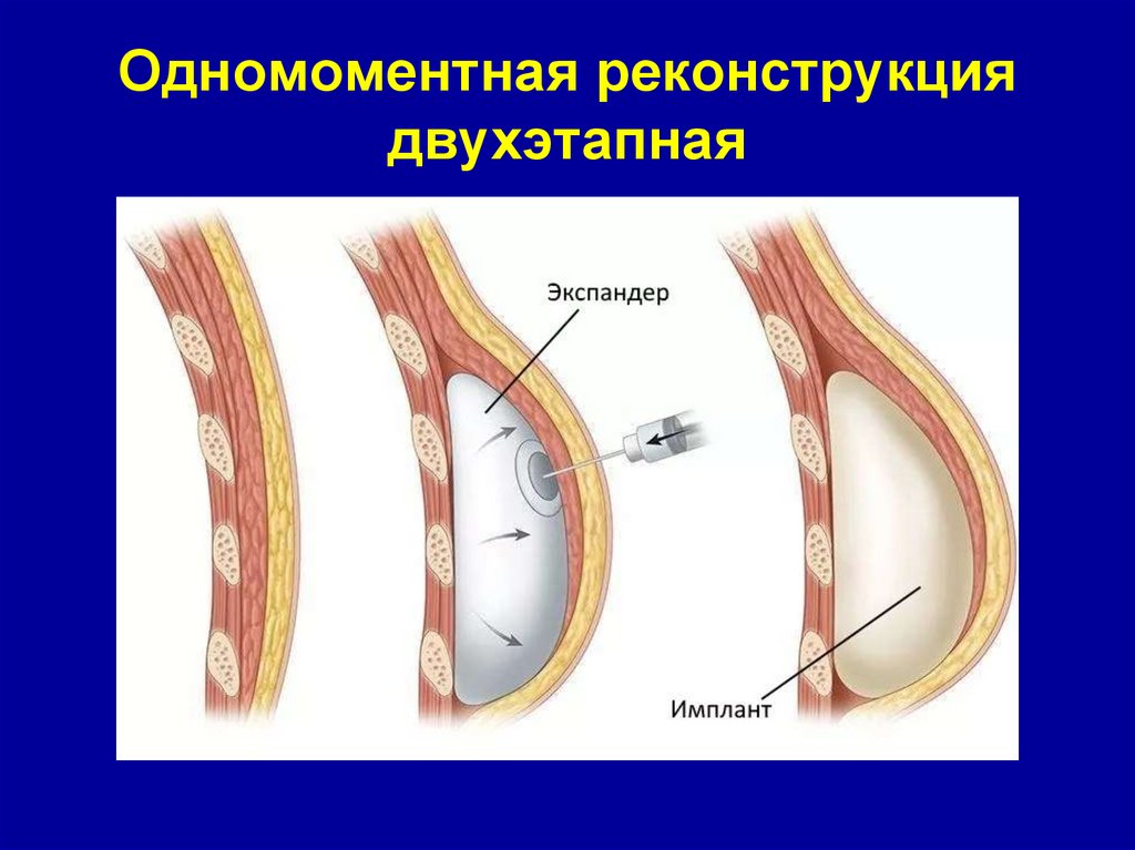 Одномоментная реконструкция двухэтапная
