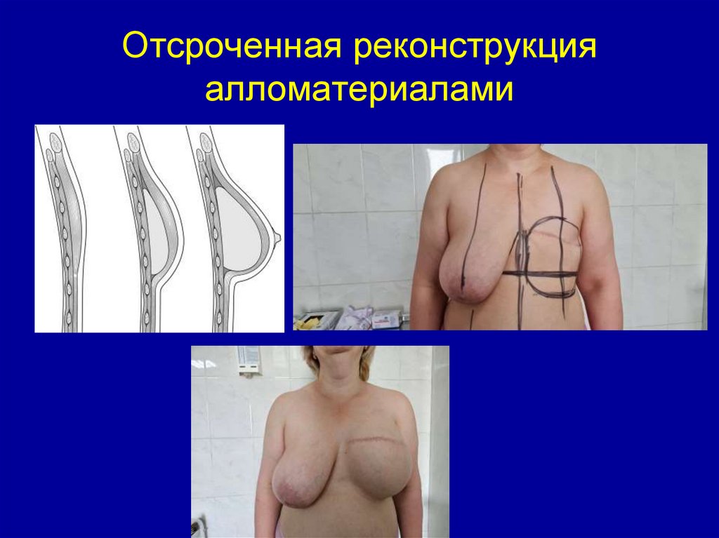 Отсроченная реконструкция алломатериалами