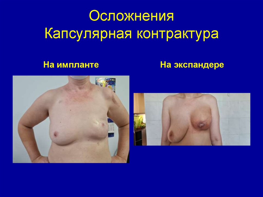 Осложнения Капсулярная контрактура