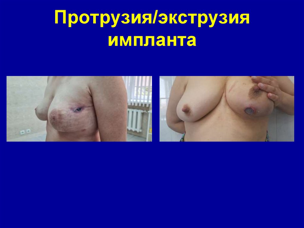Протрузия/экструзия импланта