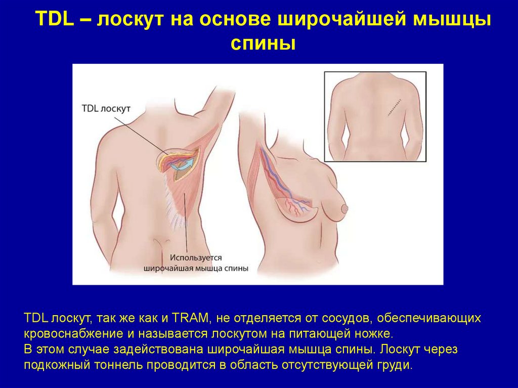 TDL – лоскут на основе широчайшей мышцы спины