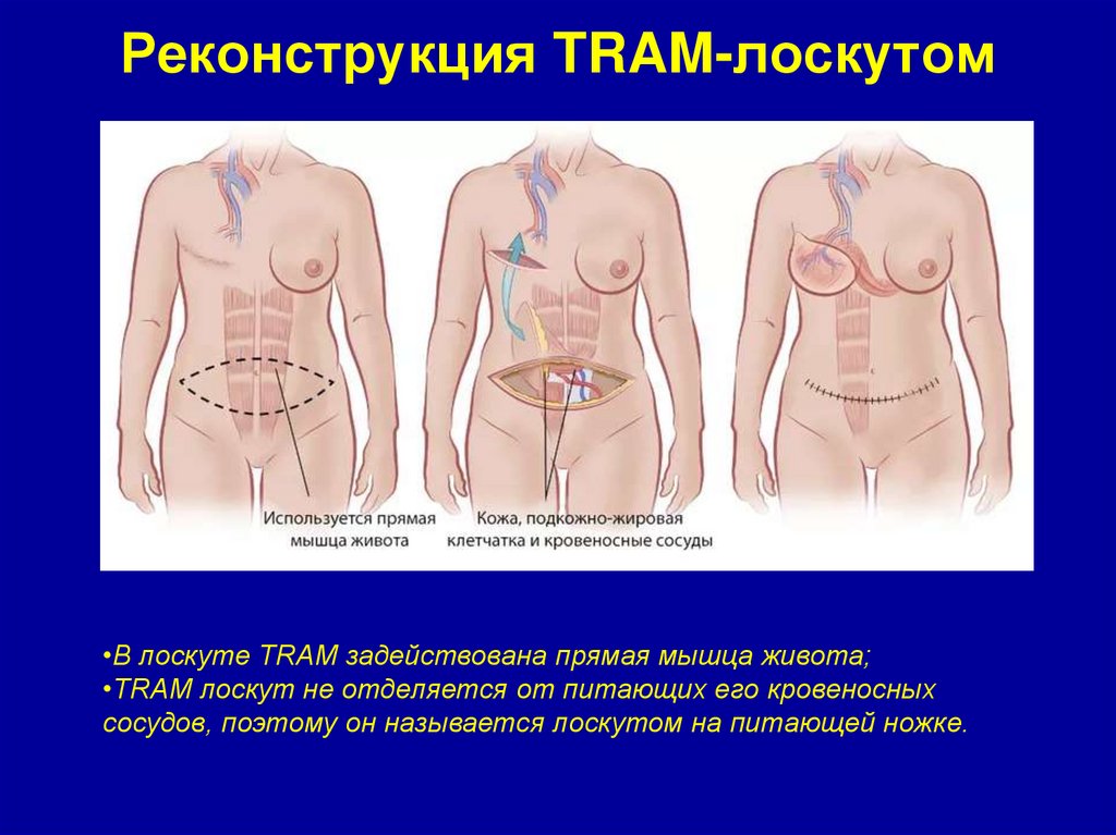 Реконструкция TRAM-лоскутом