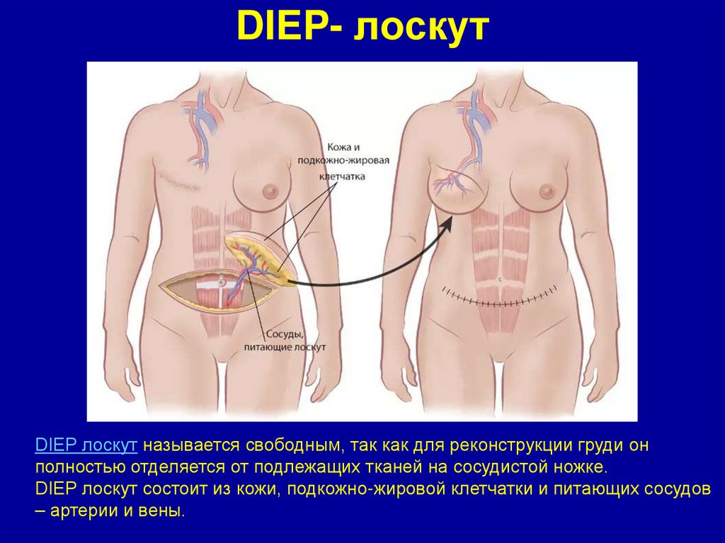 DIEP- лоскут