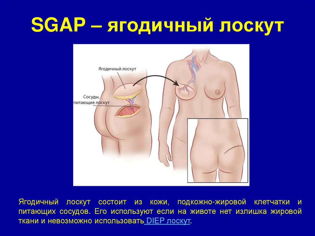SGAP – ягодичный лоскут