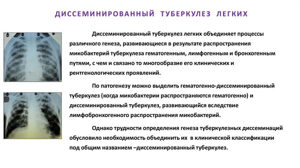 ДИССЕМИНИРОВАННЫЙ ТУБЕРКУЛЕЗ ЛЕГКИХ