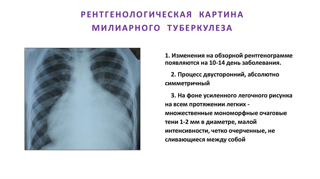 РЕНТГЕНОЛОГИЧЕСКАЯ КАРТИНА МИЛИАРНОГО ТУБЕРКУЛЕЗА