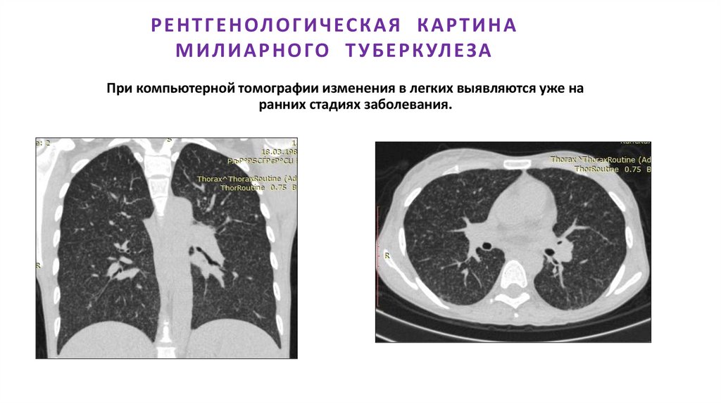 РЕНТГЕНОЛОГИЧЕСКАЯ КАРТИНА МИЛИАРНОГО ТУБЕРКУЛЕЗА