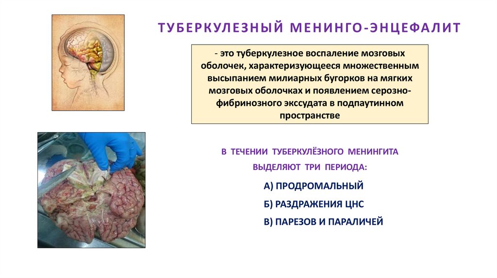 ТУБЕРКУЛЕЗНЫЙ МЕНИНГО-ЭНЦЕФАЛИТ