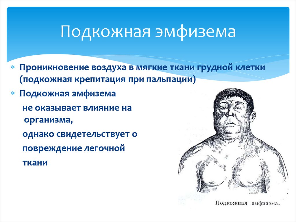 Подкожная эмфизема