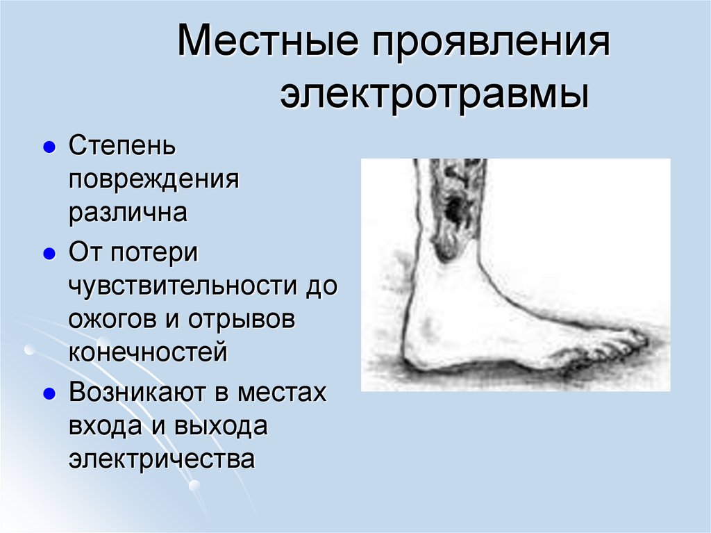 Местные проявления электротравмы
