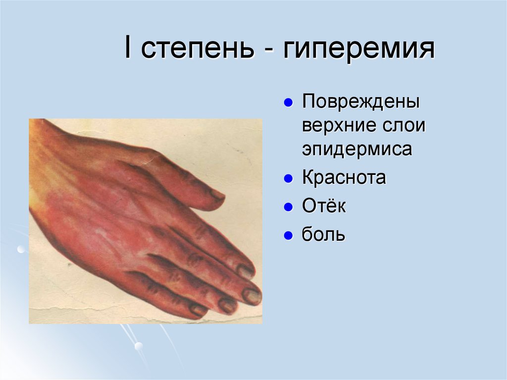 I степень - гиперемия