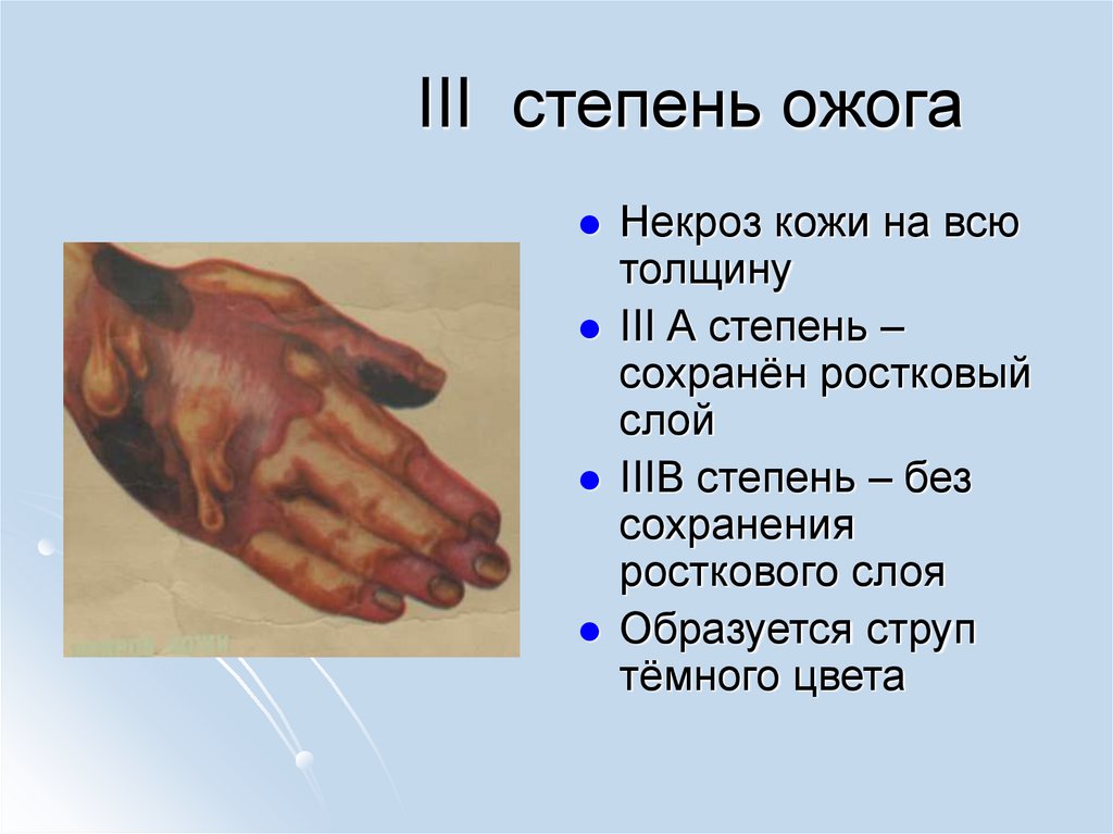III степень ожога