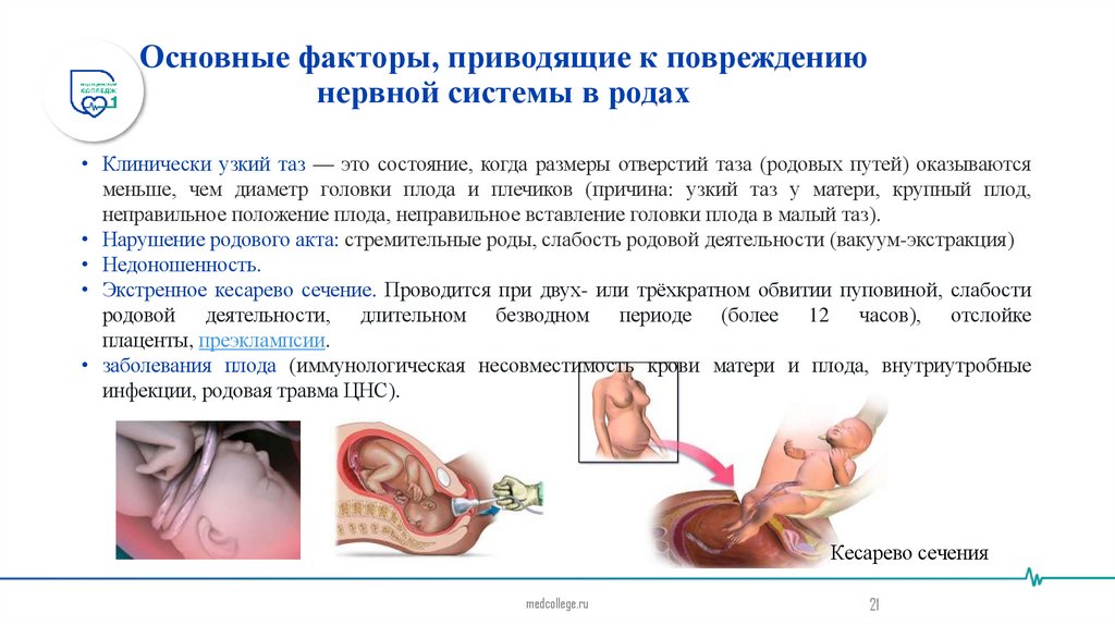 Основные факторы, приводящие к повреждению нервной системы в родах