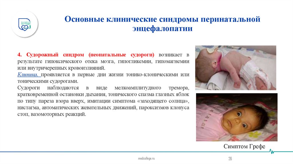 Основные клинические синдромы перинатальной энцефалопатии