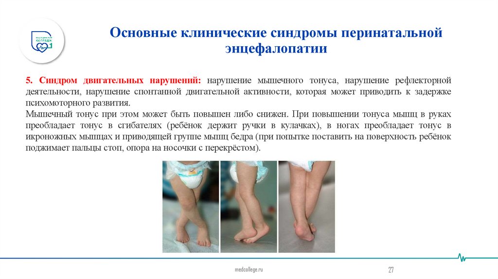 Основные клинические синдромы перинатальной энцефалопатии