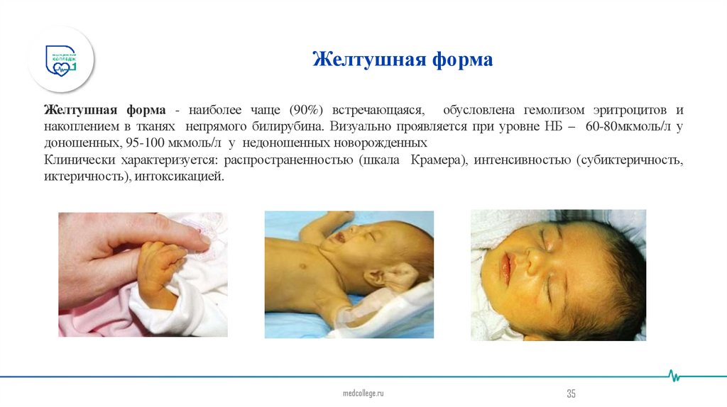 Желтушная форма