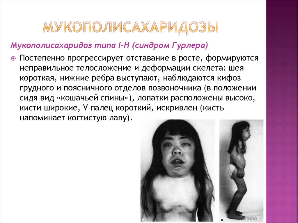 Мукополисахаридозы