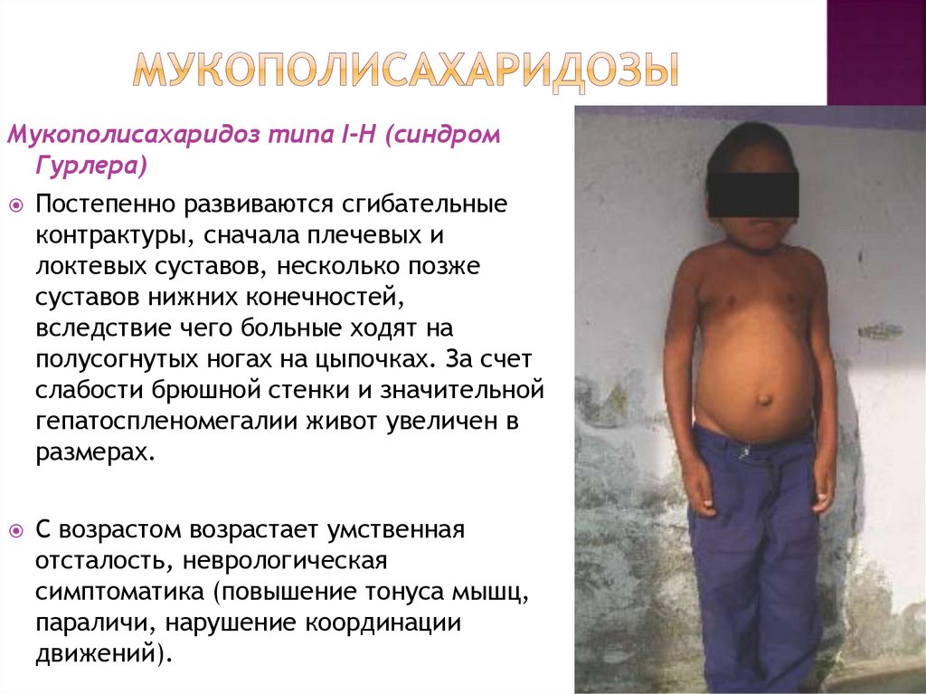 Мукополисахаридозы