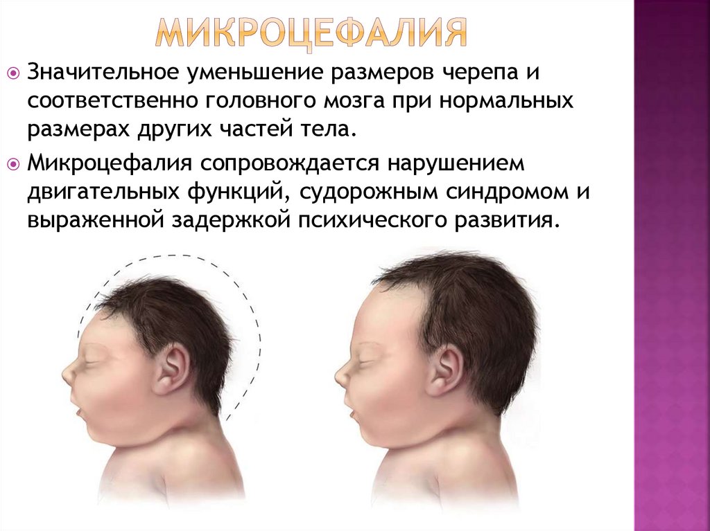 микроцефалия