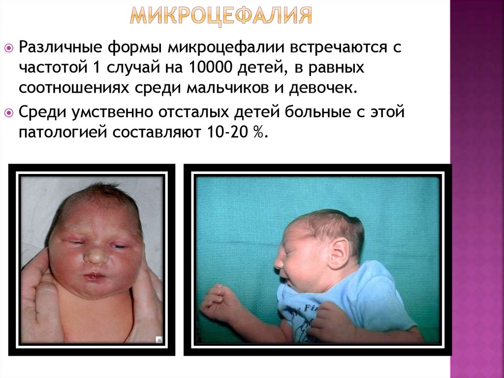 микроцефалия