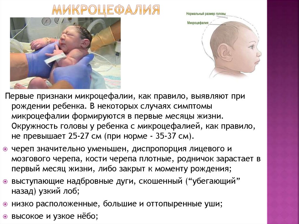 микроцефалия