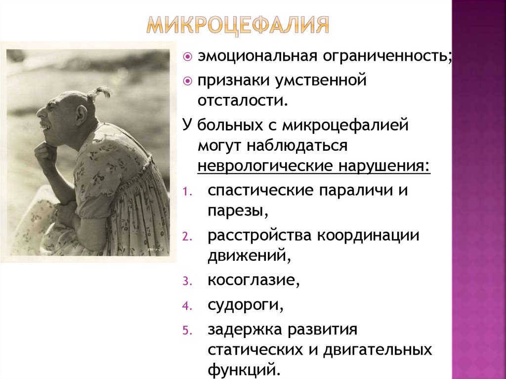 микроцефалия