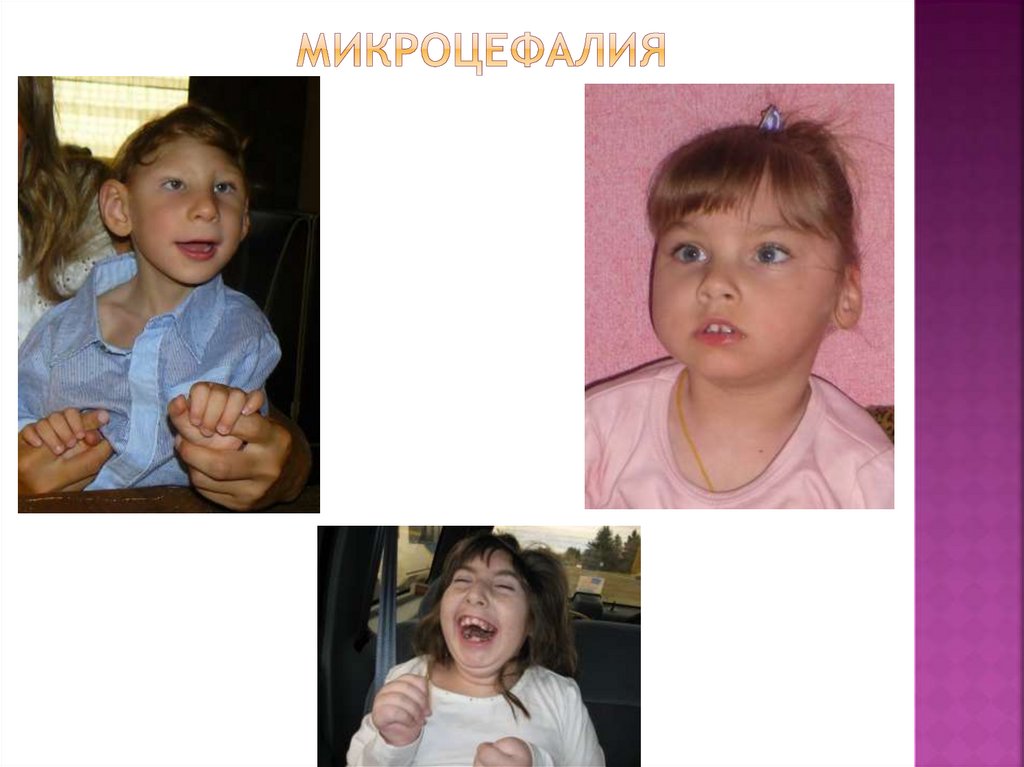 микроцефалия