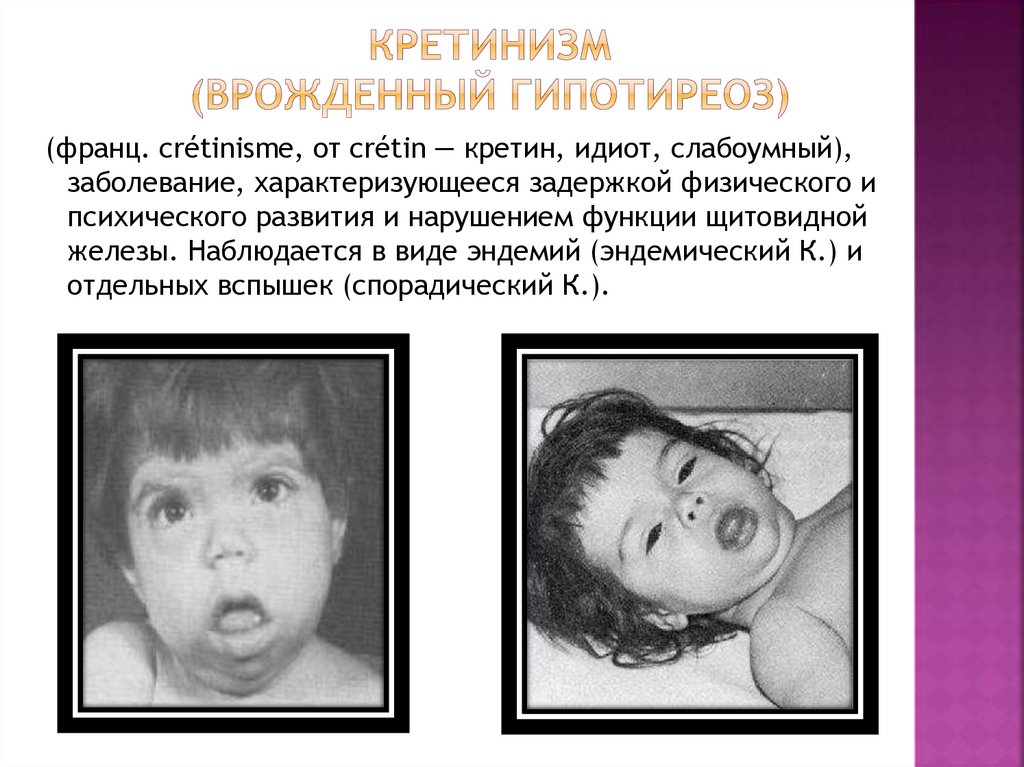 Кретинизм (врожденный гипотиреоз)