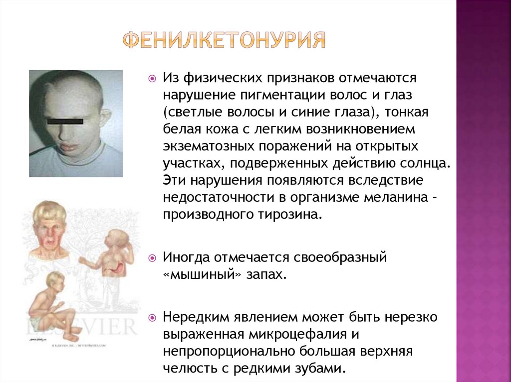 Фенилкетонурия