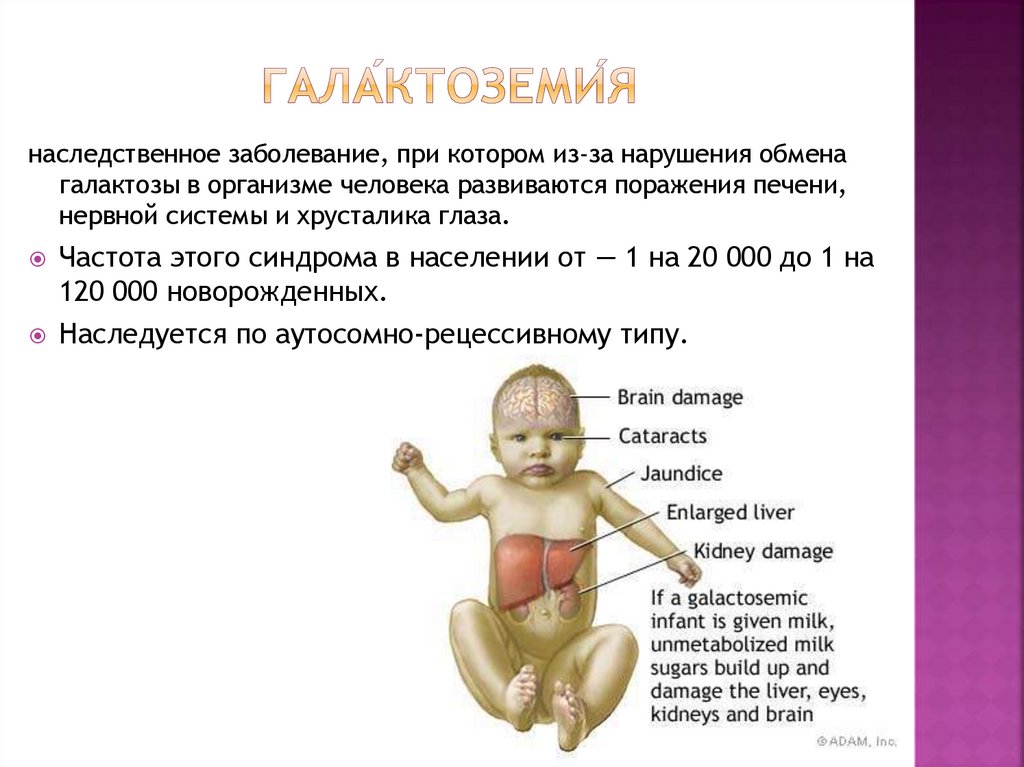 Гала́ктоземи́я