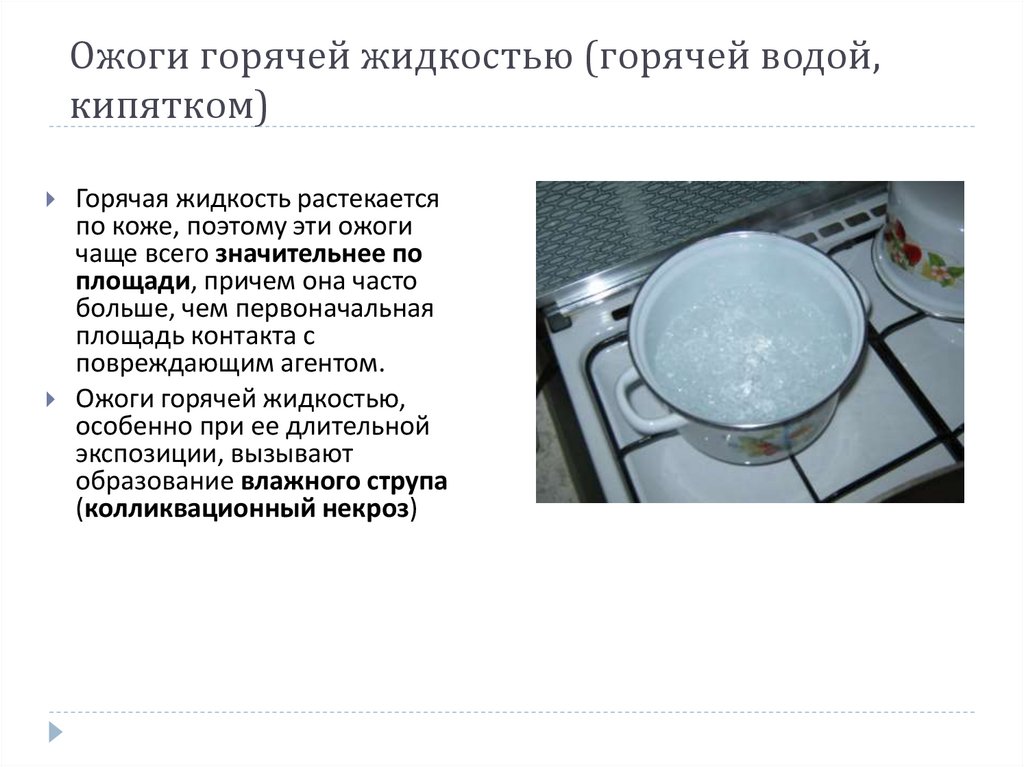 Ожоги горячей жидкостью (горячей водой, кипятком)