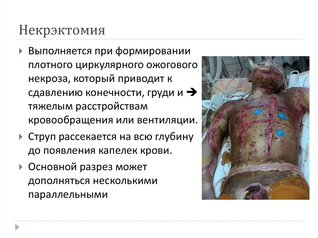 Некрэктомия